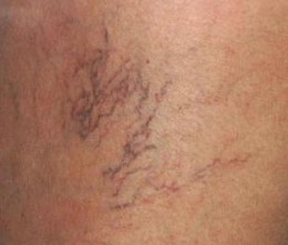 spider veins
